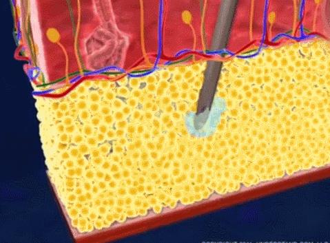 瘦的代价是什么,抽脂代价