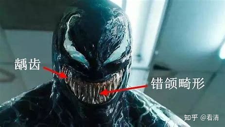 戴牙套是什么感觉,补牙后戴牙套的危害