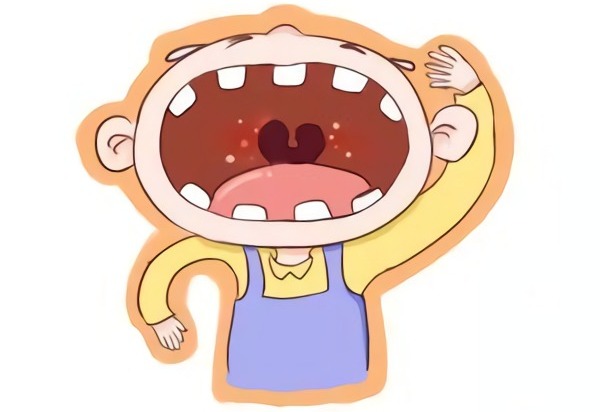 疱疹性咽峡炎有办法预防吗,疱疹性咽峡炎痊愈后要注意什么