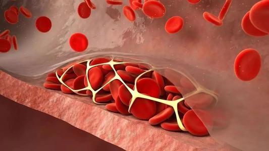 高血压与高血脂的关系,高血压与高血脂有直接的关系