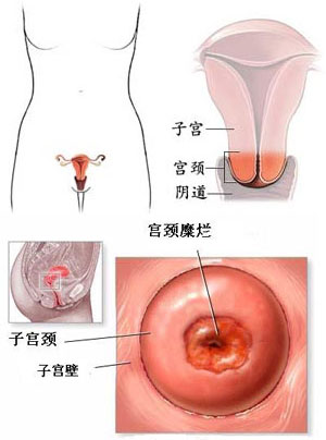 宫颈炎症引起的什么癌,宫颈癌细胞病变