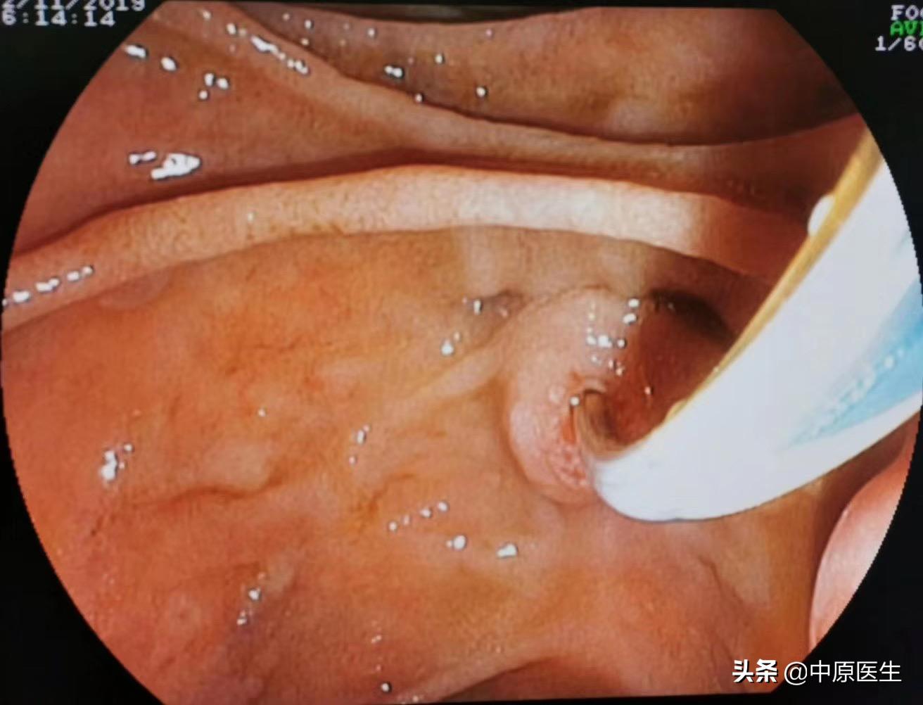 十二指肠与哪个器官对应,与十二指肠相邻的有哪些器官