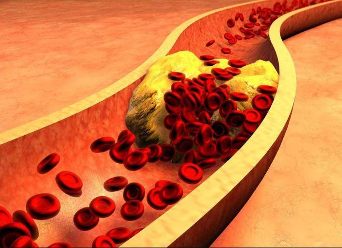 血管堵别害怕一通百通,心血管哪个位置的血管堵塞最危险