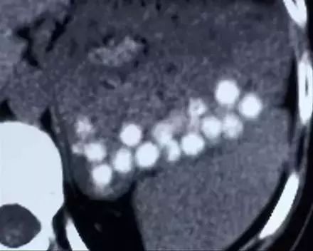 珍珠奶茶里的珍珠能被消化吗,珍珠奶茶会形成结石吗