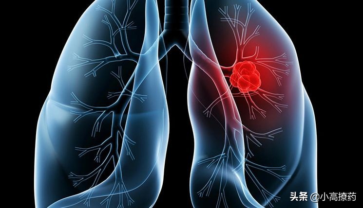 关于肺癌的基本常识,肺癌ii期是什么意思