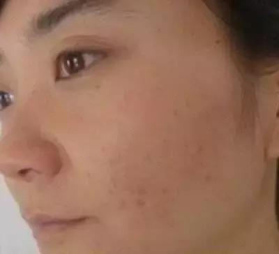 日本的美白针,日本最强美白针