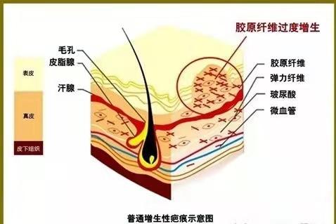 原来疤痕处感染化脓了怎么处理,刚刚形成的疤痕疙瘩怎么治疗