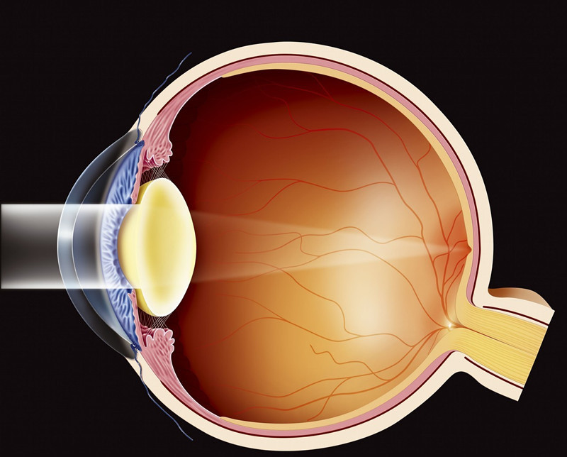 看电脑眼睛变熊猫眼,高度近视诱发白内障