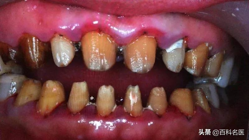 烤瓷白牙维持多长时间,做烤瓷白牙能管多久