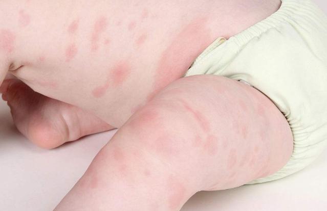 明确过敏原之后才能正确预防过敏,常见的过敏原都有哪些你了解吗