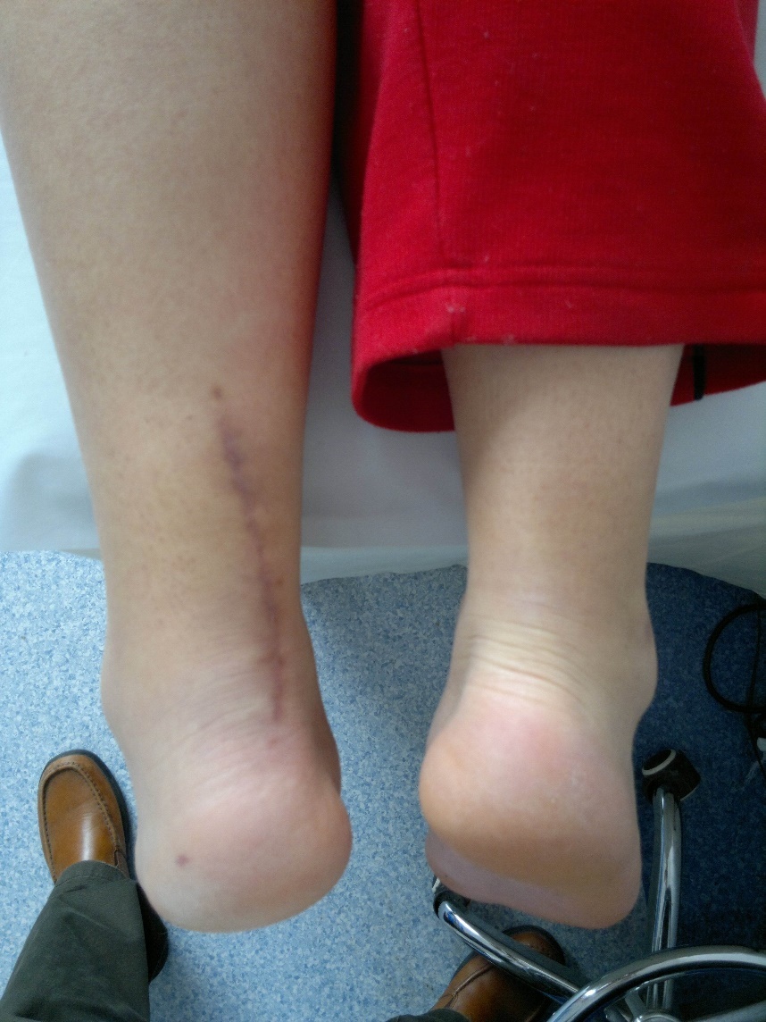 跟腱陈旧性断裂缝合方法有哪几种,陈旧性跟腱断裂能治好吗