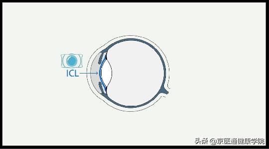 近视手术哪种手术对眼睛伤害小,激光近视手术好还是晶体手术好