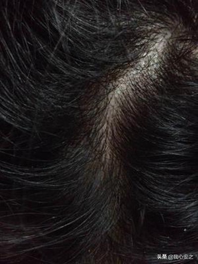 饱受毛囊炎的折磨,被真菌毛囊炎折磨
