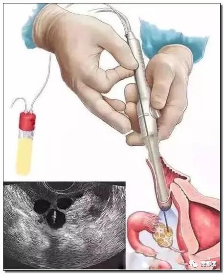 纽约通过合法代孕!中国女性千万要注意,代孕已经毁了很多女孩。