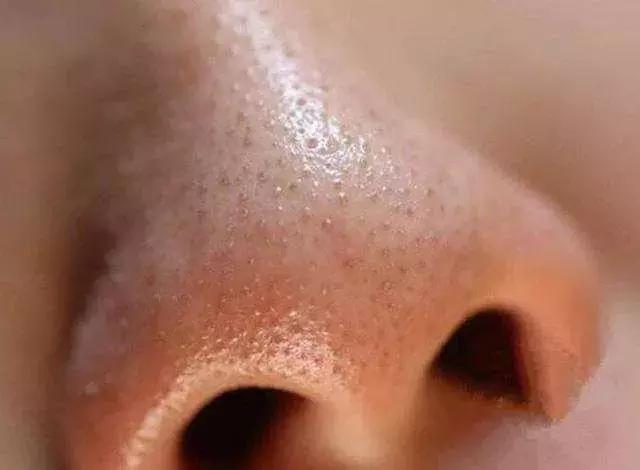 头皮痒头屑多脂溢性皮炎怎么解决,头皮油头屑大块还多脂溢性皮炎