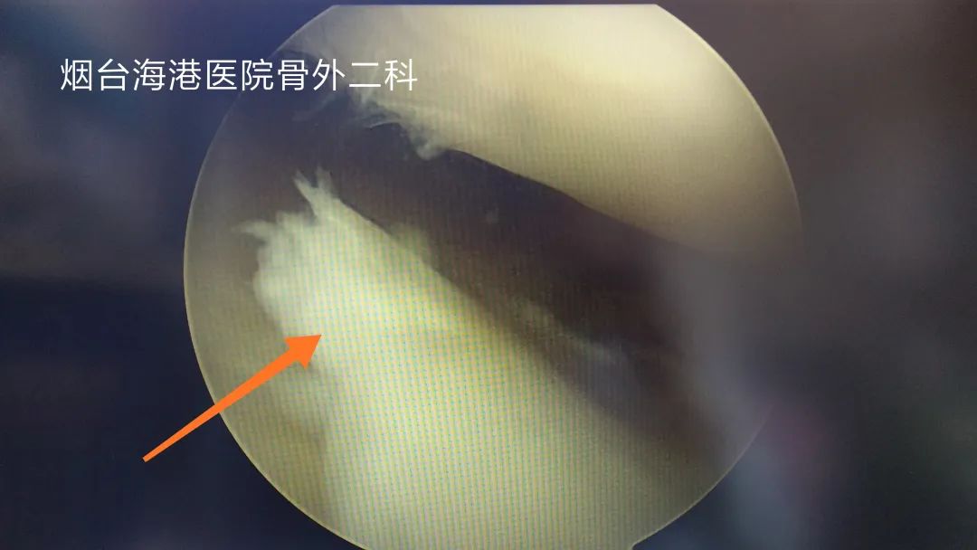 半月板手术导致骨性关节炎怎么办,关节镜治疗半月板损伤后遗症