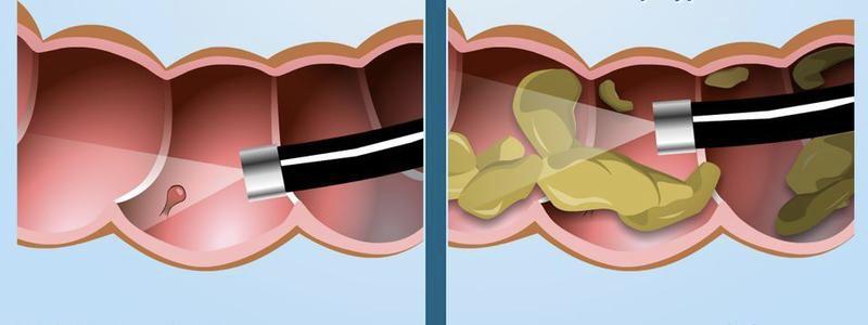 清肠不干净做肠镜能看出有肠癌吗,做肠镜检查为啥清肠清不干净