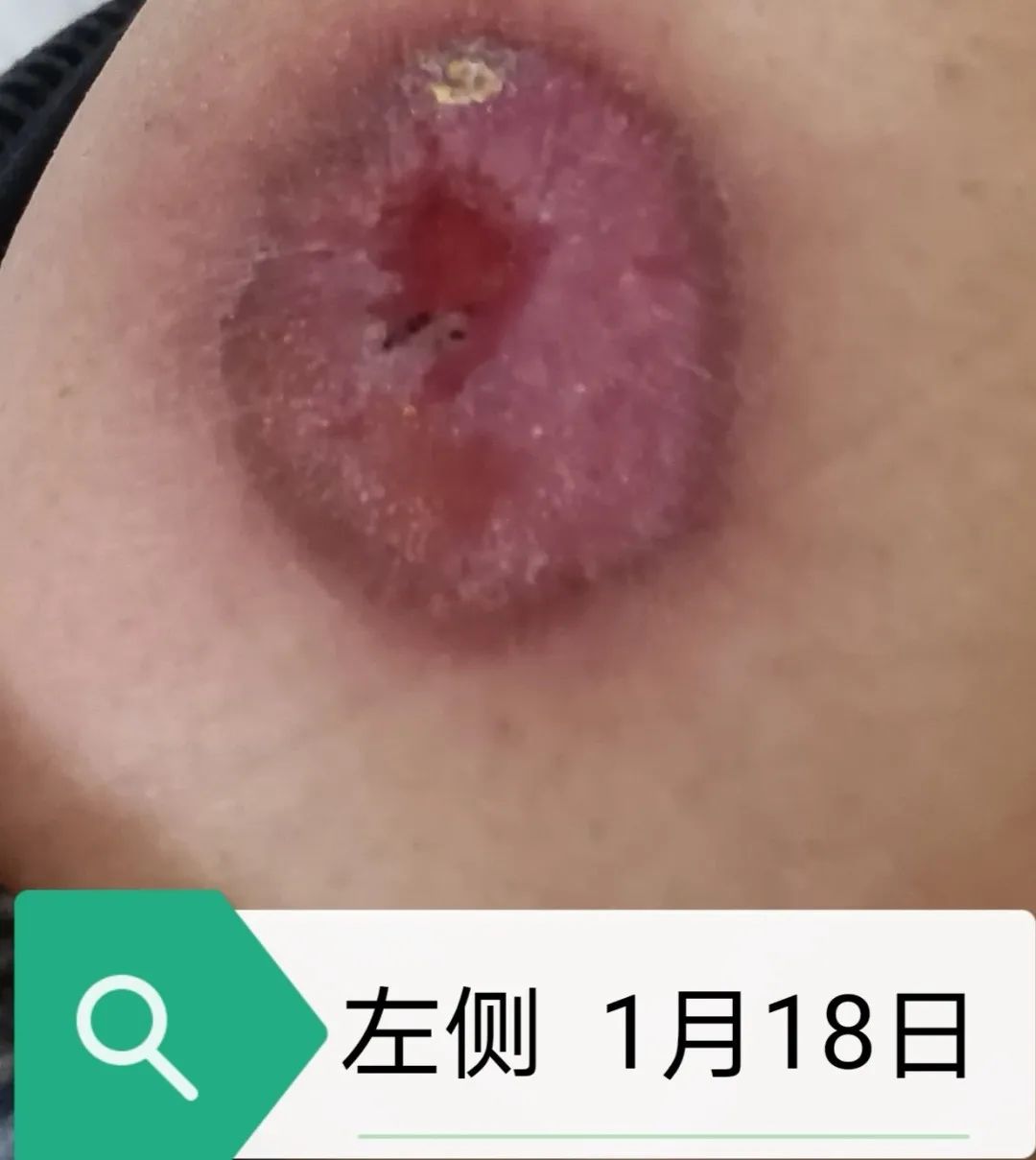 压疮的治疗成功和护理案例,压疮怎么护理好得快