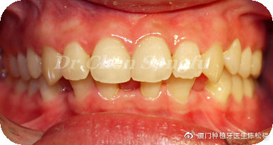 厦门种植牙陈松福,口腔正畸案例分享