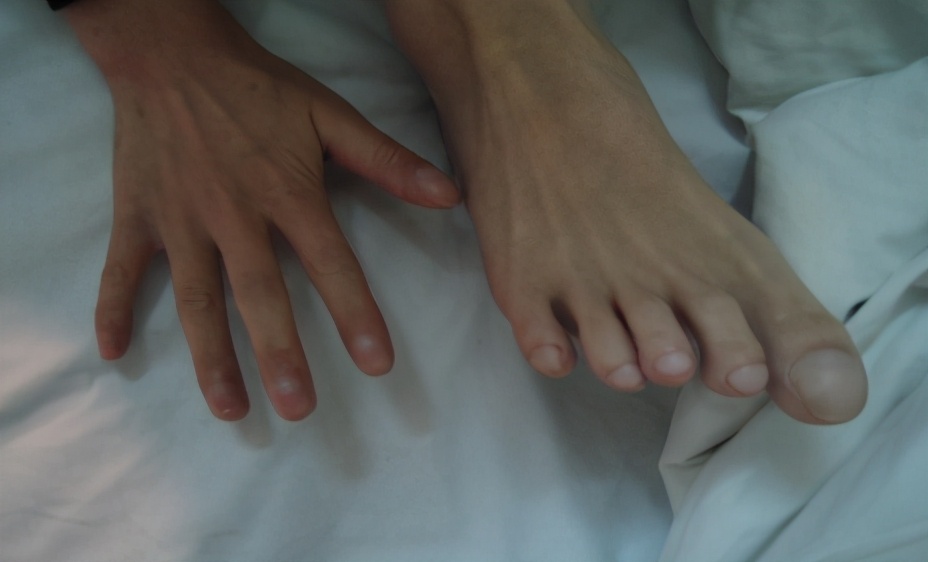 支气管扩张会导致杵状指吗,支气管扩张有杵状指吗