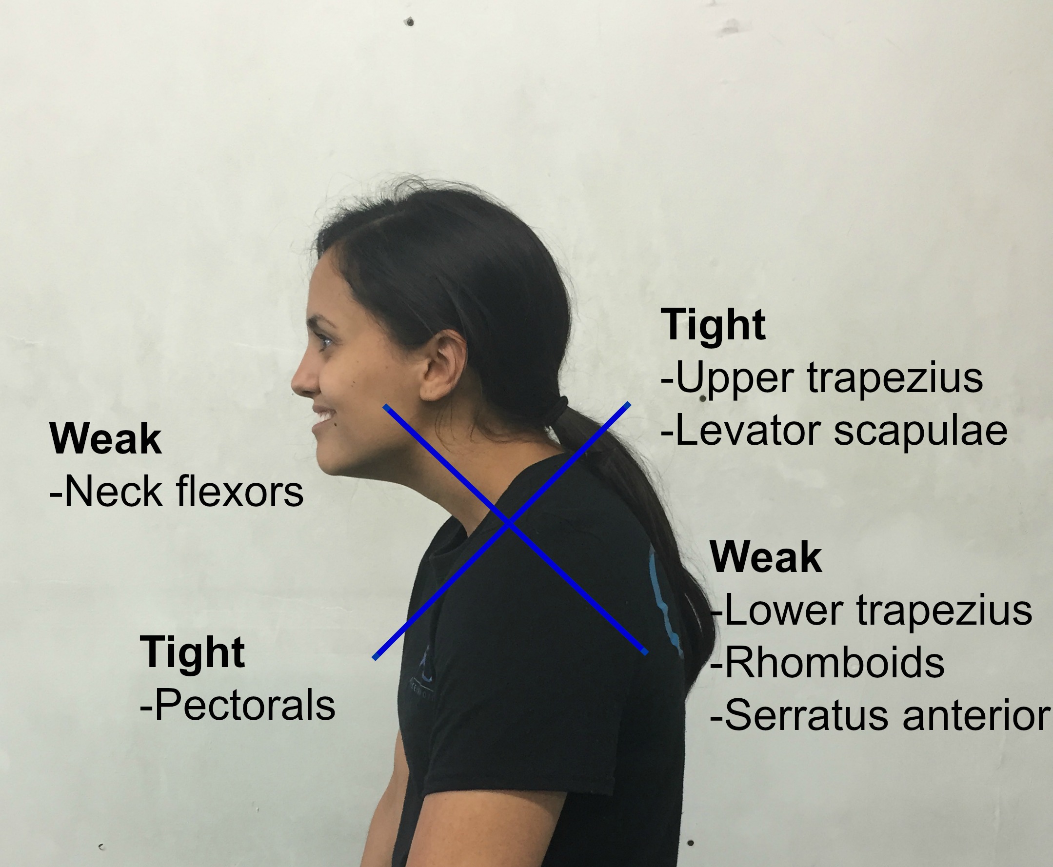 靠墙站真的可以矫正驼背伸脖子吗？