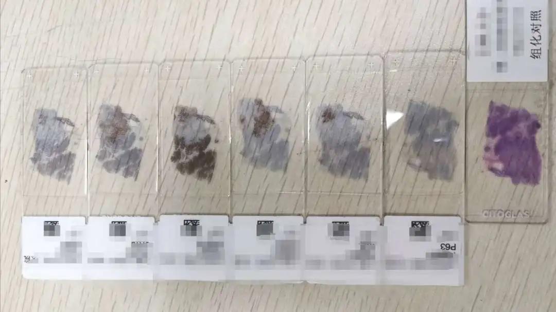 病理报告为什么这么慢,手术后病理报告准确率高吗