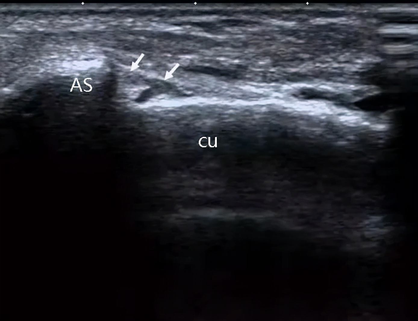 手麻肌电图检查过程视频,手麻脚麻肌电图正常