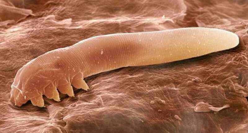 痘痘类型的黑头,痘痘黑头主要成分