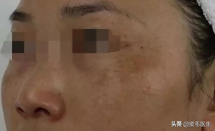 褐斑祛斑最有效方法,年轻人脸上长褐斑老年斑如何治疗