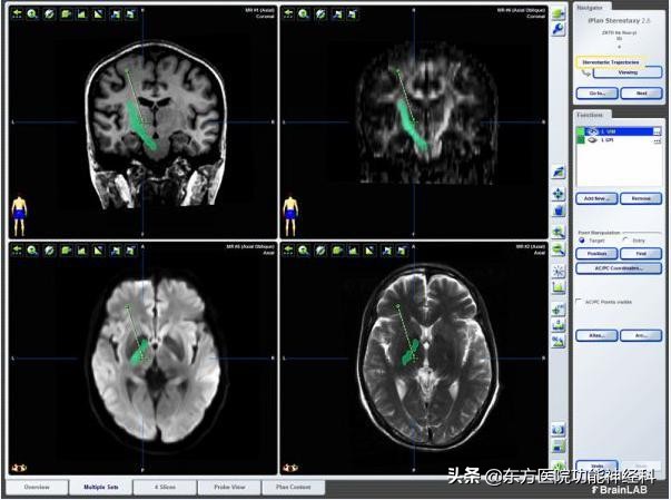 抽动秽语症手术治疗成年人,抽动秽语综合征治疗的研究