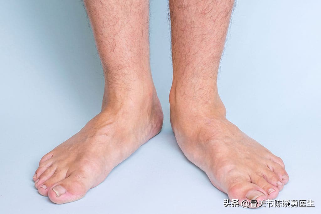 腰间盘突出跑步一跑就脚麻,跑步的时候脚麻是怎么回事