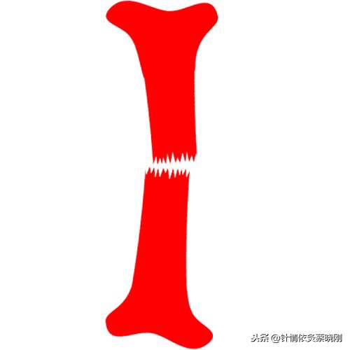 适宜针灸调理的常见病证-针灸对促进骨折愈合有良好的临床疗效