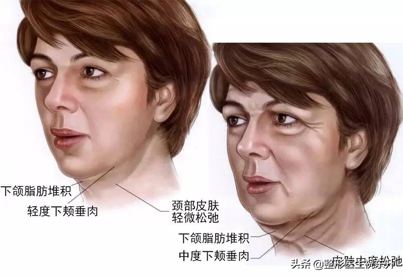 35岁面部松弛下垂做什么项目,35岁眼袋下垂松弛