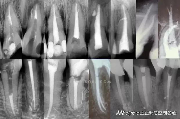 根管治疗难点与解决方案,根管治疗牢固吗