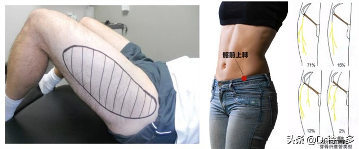 大腿内侧痛,胯也痛...有根神经被卡住了