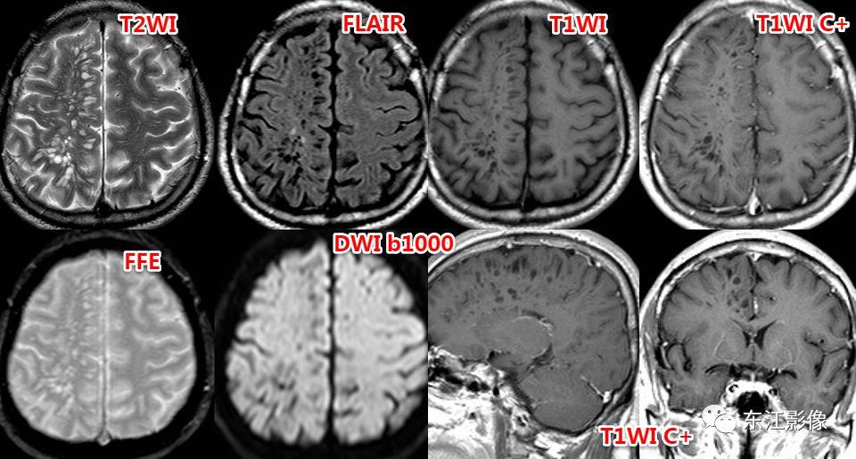 头颅mri扫描影像哪里找,头颅影像mra详细解说