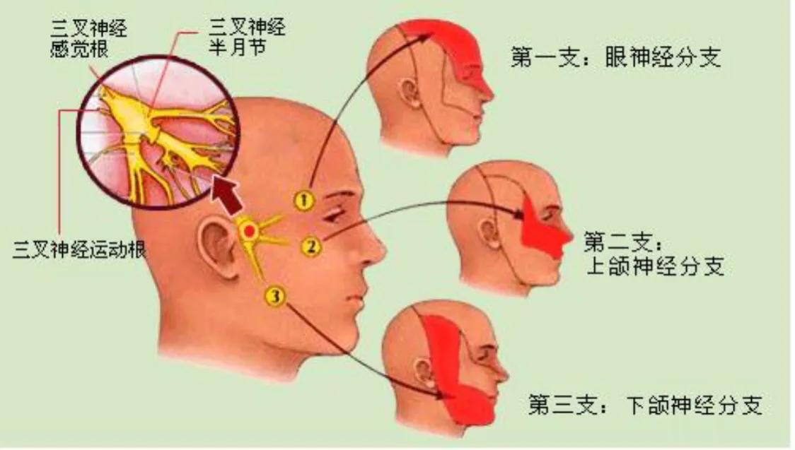 三叉神经痛偏方除根,三叉神经痛的最佳解决办法