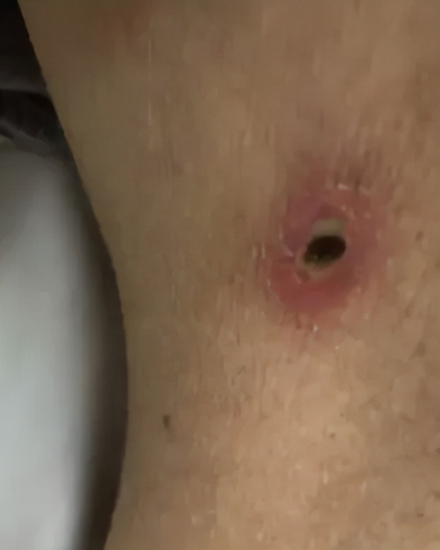 被毒虫咬伤进icu,被虫咬进icu