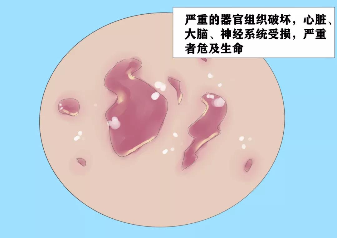 性病界的潜伏高手——梅毒