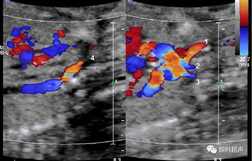 胎儿心脏三种血管关系模式图,25周的胎儿心脏弓切面多少正常