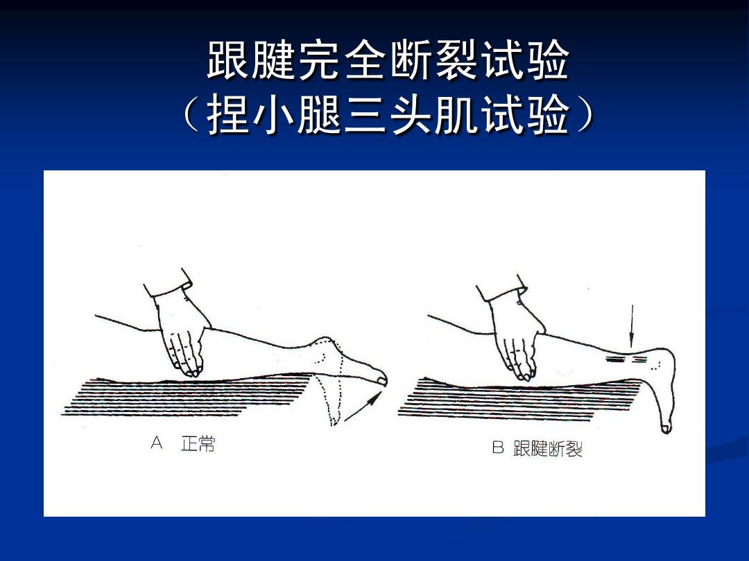 骨科医生告诉你：为什么跟腱会断？如何保护好我们的跟腱？