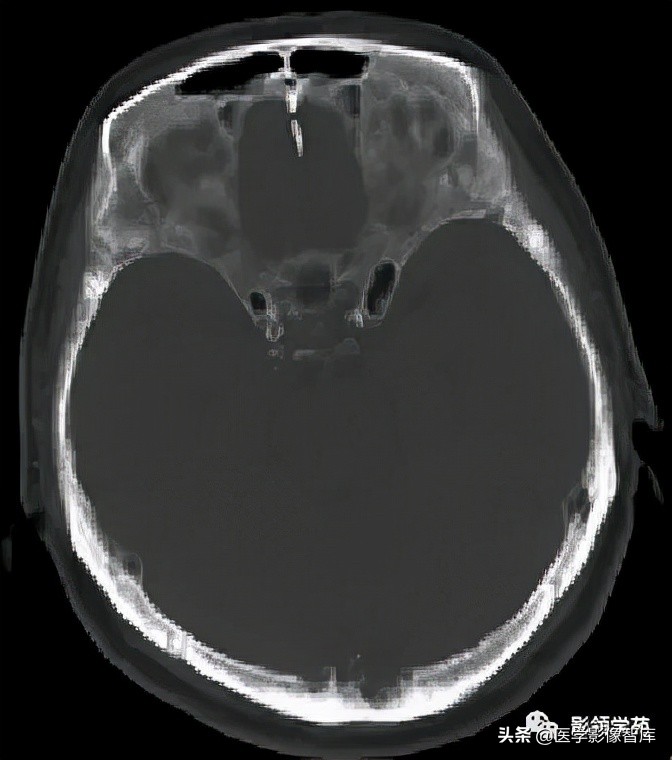 鞍区肿瘤做什么检查得出来,鞍区肿瘤的影像学鉴别