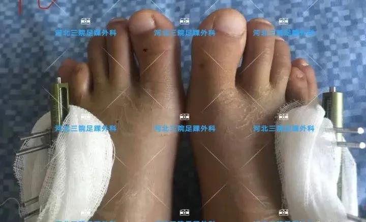 第四足趾短小怎么办,为什么第四脚趾短小