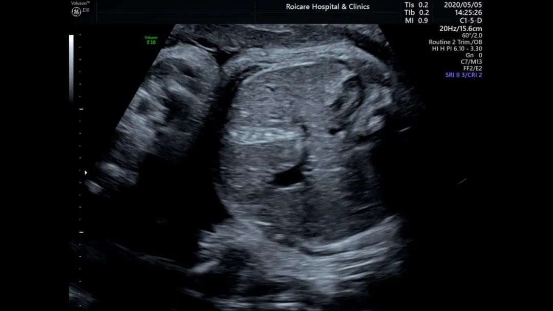 胎儿超声强回声,胎儿超声超细讲解视频