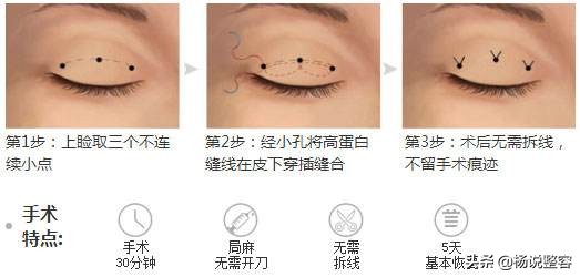埋线双眼皮是什么原理,双眼皮埋线优缺点