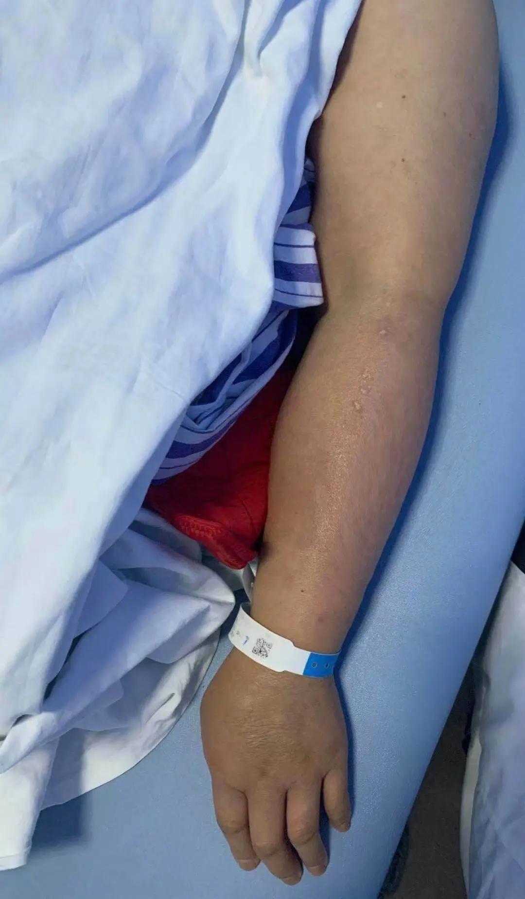 肿瘤术后淋巴水肿的cdt治疗,宫颈癌术后放疗淋巴水肿