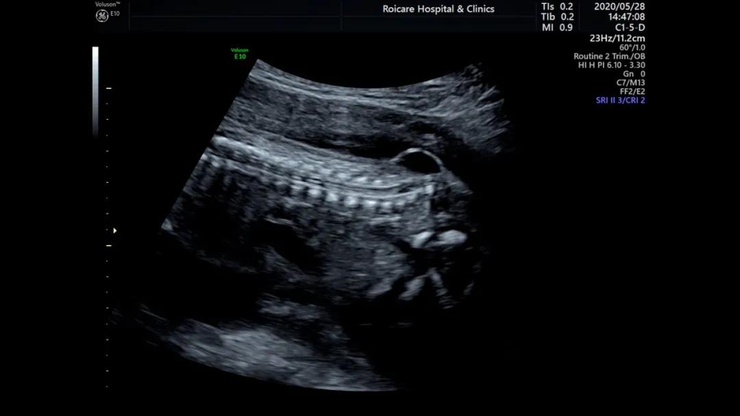 胎儿脊髓圆锥位置低是什么情况,胎儿脊髓圆锥位置偏低做核磁共振