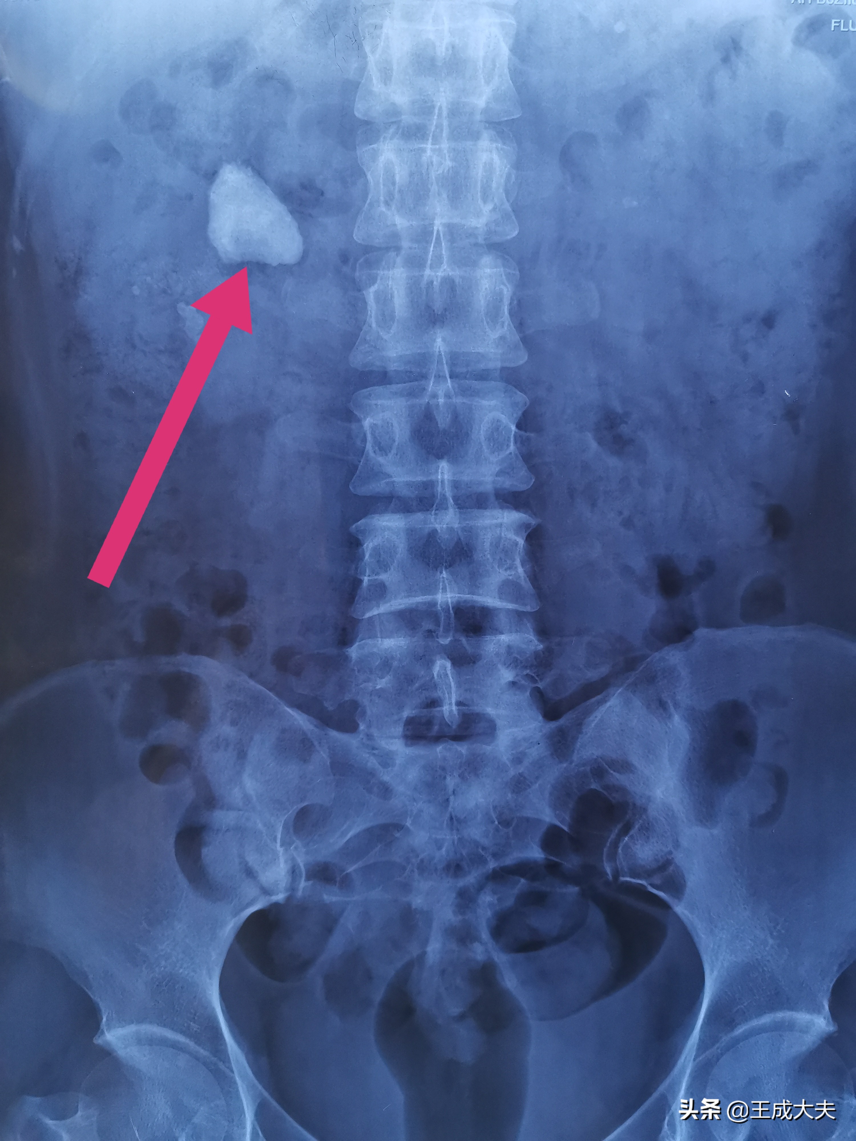 关于尿路结石的病因说法不正确,结石方面辟谣