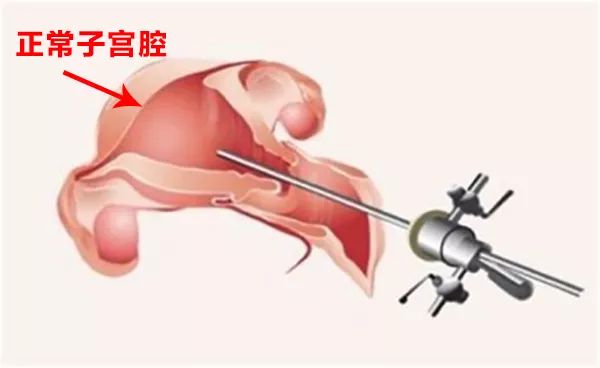 反复异常阴道出血？这个检查你需要做