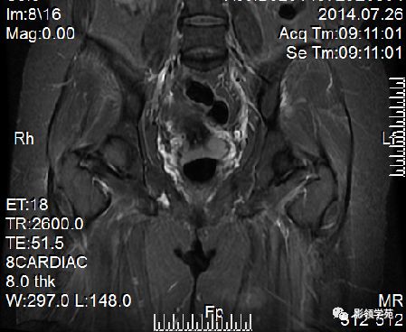 宫颈癌mri诊断,宫颈癌的mr扫描技术